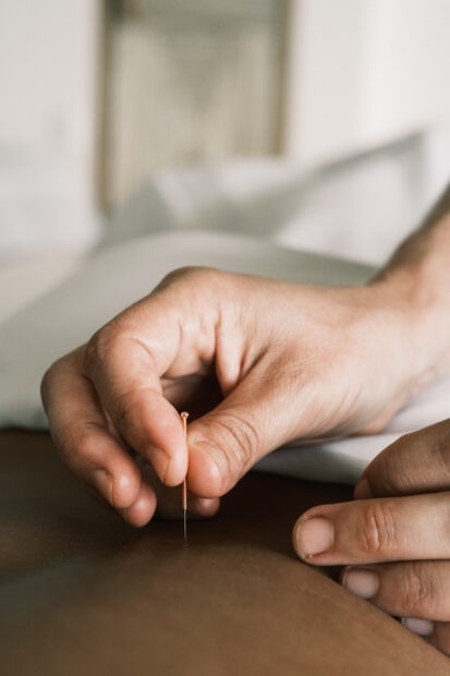 Hands placing copper acupuncture needle into back