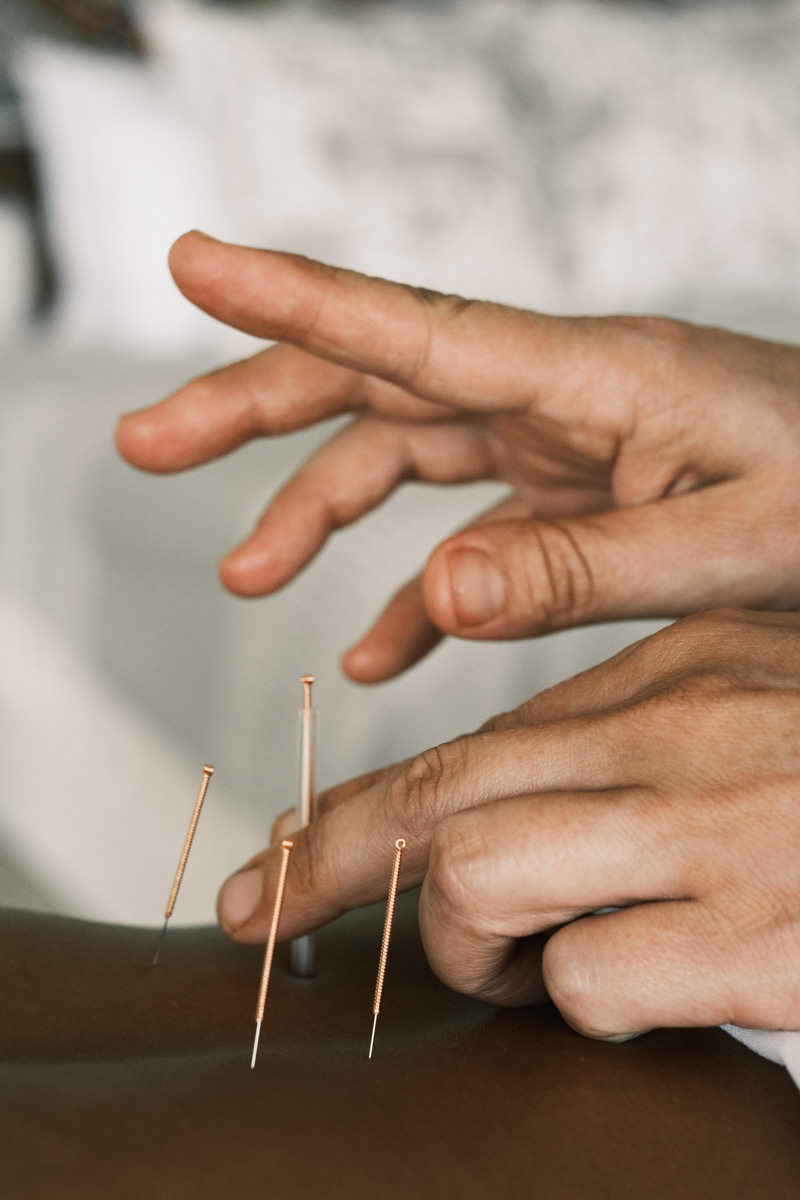 Fingers tapping in copper acupuncture needle into upper back