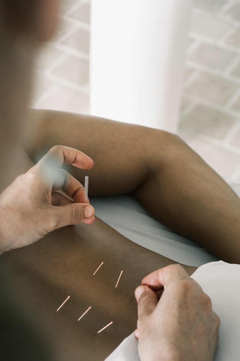 Applying copper acupuncture needles